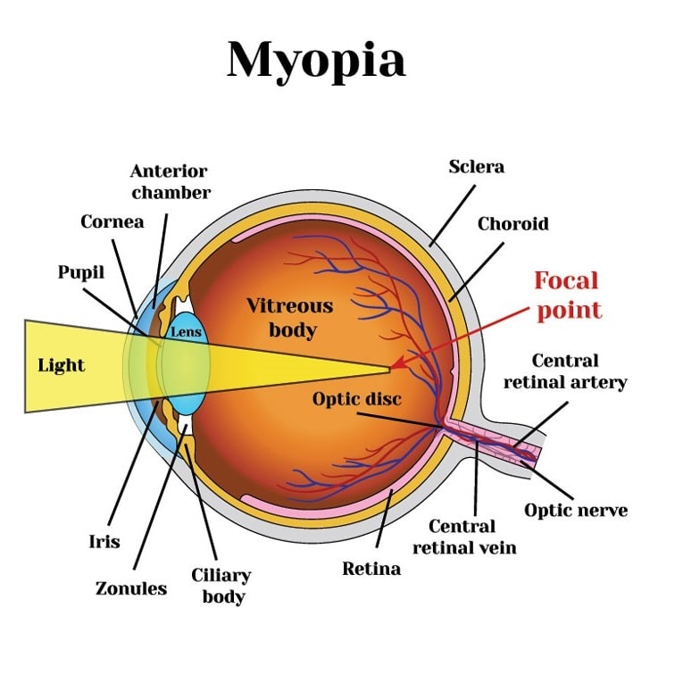 Myopic-Eyes-min.jpg